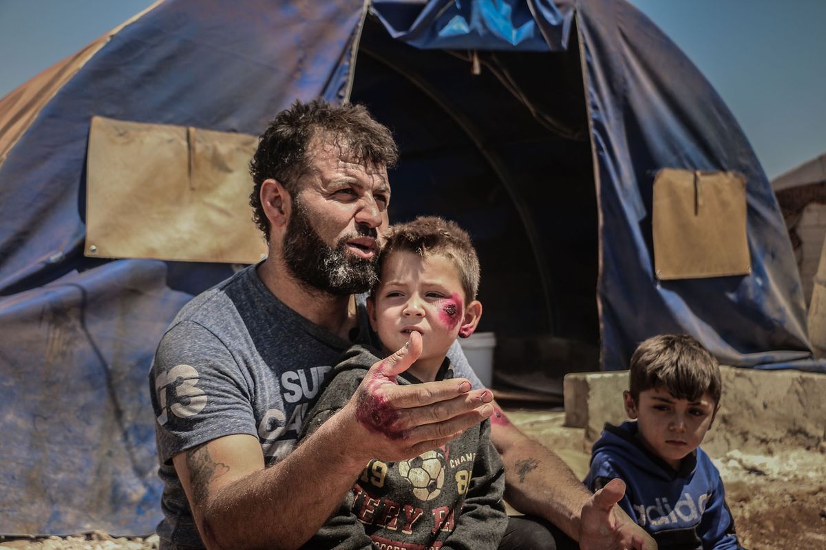 1225237637 IDLIB, SYRIA - JULY 02: A Syrian kid suffering from leishmaniasis, a parasitic disease spread by the bite of phlebotomine sandflies, is seen in a refugee camp in Idlib, Syria on July 02, 2020. In the refugee camps in Idlib, danger of leishmaniasis disease arose due to inadequate living conditions and insufficient health services. In the camps where sheltered civilians escaping from the attacks of Assad regime and its supporters, infrastructure problems, especially exposed septic pits and damaged sewers, cause the spread of the disease. (Photo by Muhammed Abdullah/Anadolu Agency via Getty Images)