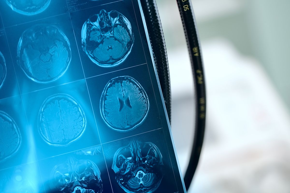 Mr,Image,In,Frontal,Section,Of,Patient,Brain.
MR image in frontal section of patient brain.