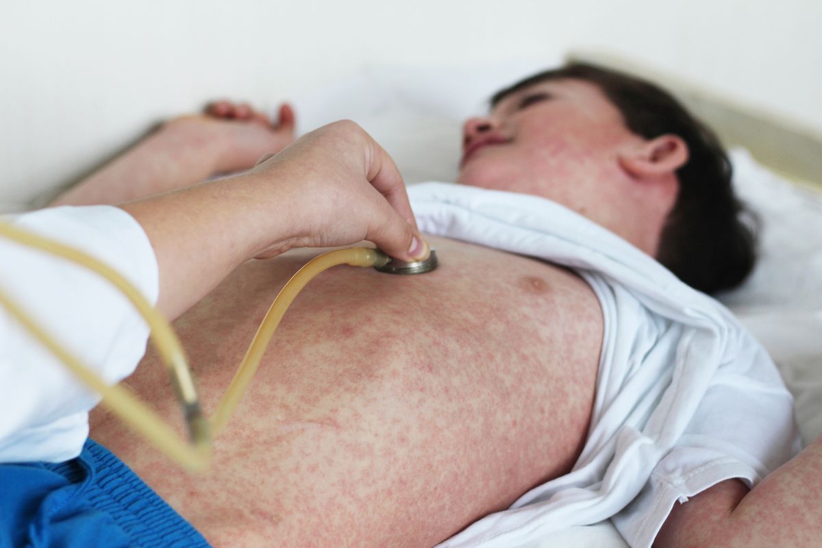 Measles,Rash.,Child,With,Allergy,Rush.,Doctor,And,Patient