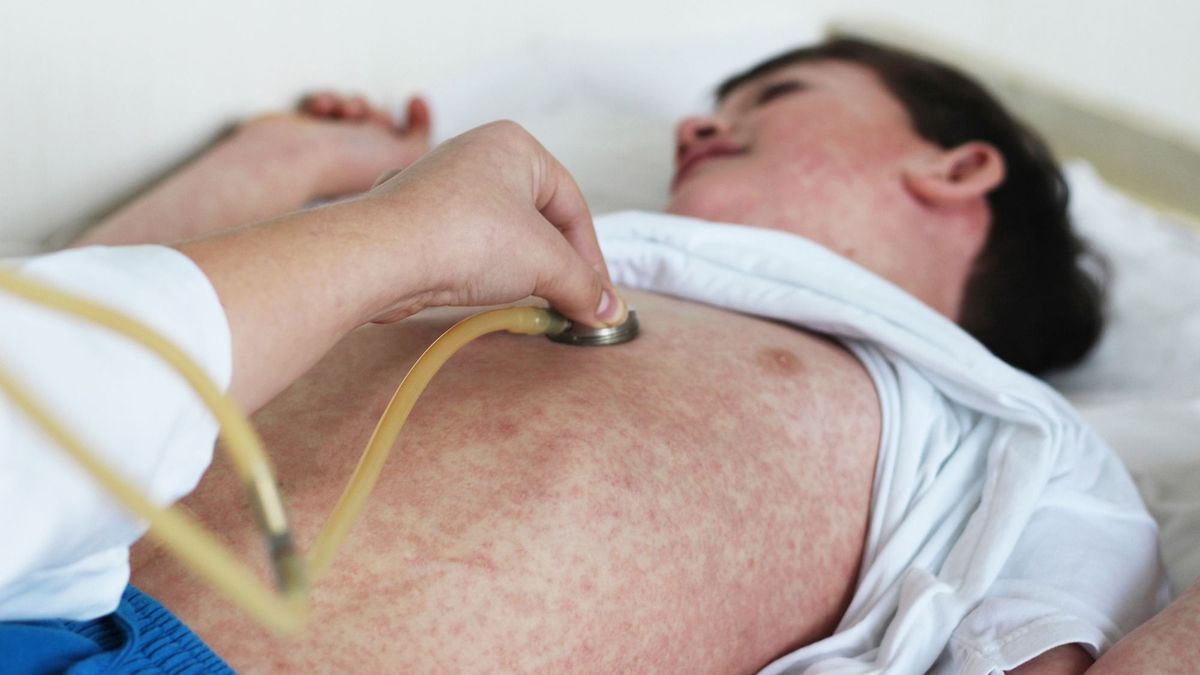 Riasztóan terjed világszerte a kanyaró