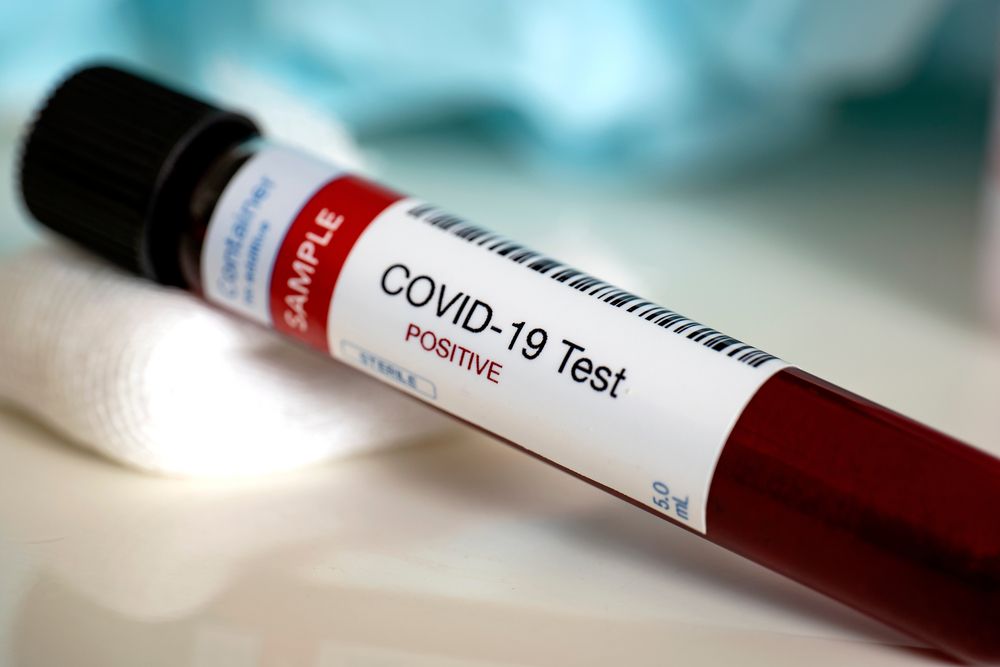 Blood,Test,Samples,For,Presence,Of,Coronavirus,(covid-19),Tube,Containing