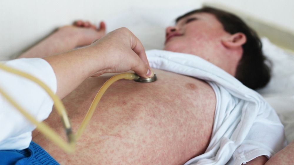 Measles,Rash.,Child,With,Allergy,Rush.,Doctor,And,Patient