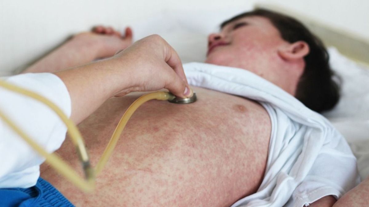 Kanyarójárványra figyelmeztetnek Ausztriában is