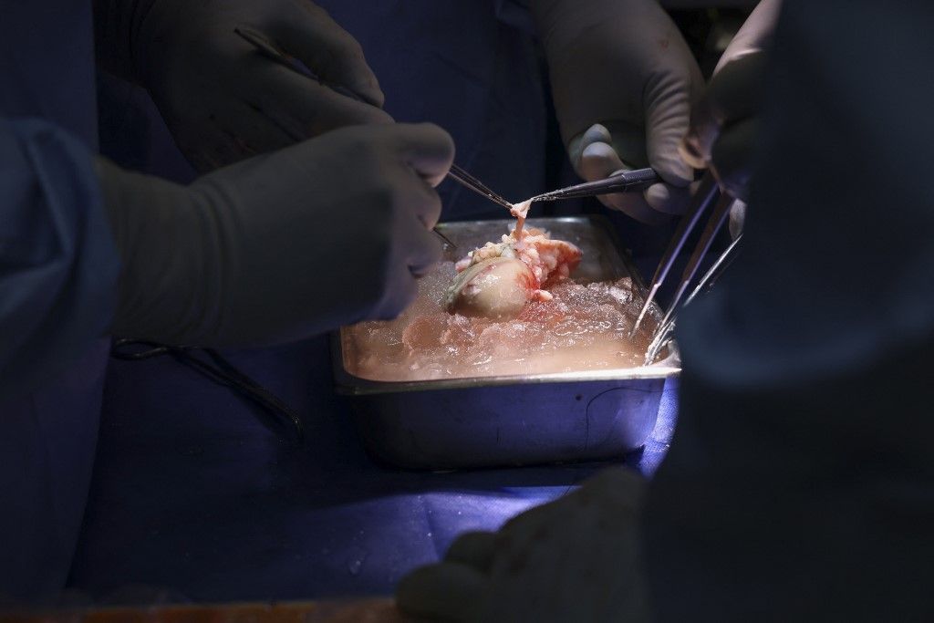 In this March 16, 2024, image courtesy of the Massachusetts General Hospital in Boston, Massachusetts, surgeons prepare the pig kidney for transplantation during the world’s first genetically modified pig kidney transplant into a living human. A team of surgeons have successfully transplanted a pig kidney into a living patient for the first time, the hospital said on March 21, 2024. The four-hour-long operation was carried out on March 16 on a 62-year-old man suffering from end-stage kidney disease, the hospital said. (Photo by Michelle ROSE / Massachusetts General Hospital / AFP) / RESTRICTED TO EDITORIAL USE - MANDATORY CREDIT "AFP PHOTO / Massachusetts General Hospital/Michelle ROSE" - NO MARKETING NO ADVERTISING CAMPAIGNS - DISTRIBUTED AS A SERVICE TO CLIENTS
Meghalt az első, sertésvesével élő ember.