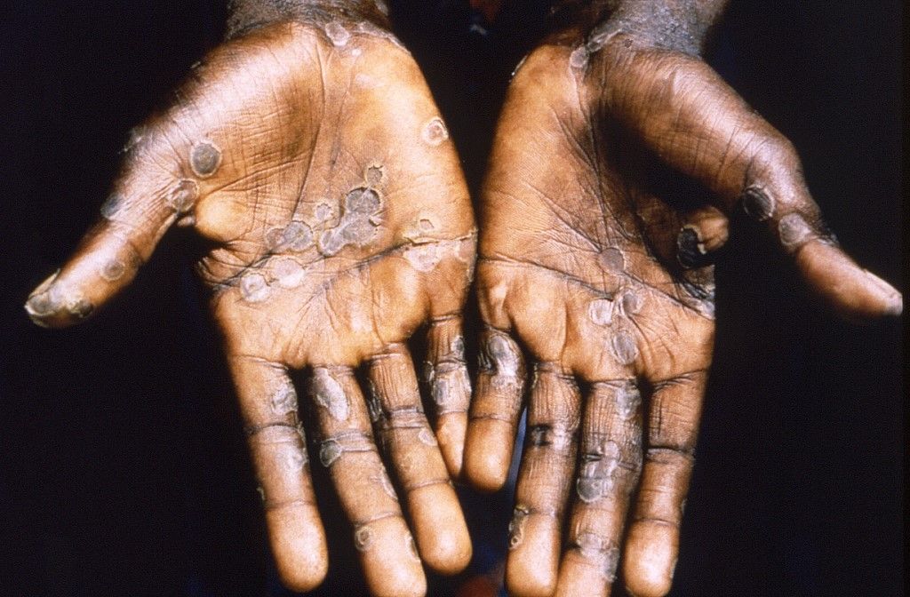 Palms of a patient with a case of monkeypox, majomhimlő, Kongó, 