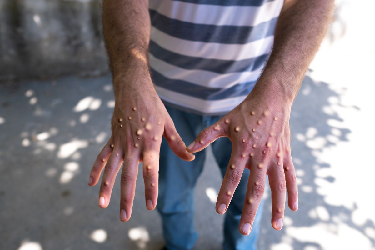 Man with blisters on his hands from monkeypox. majomhimlő