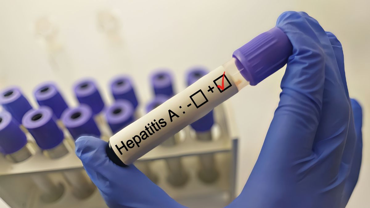 hepatitis A