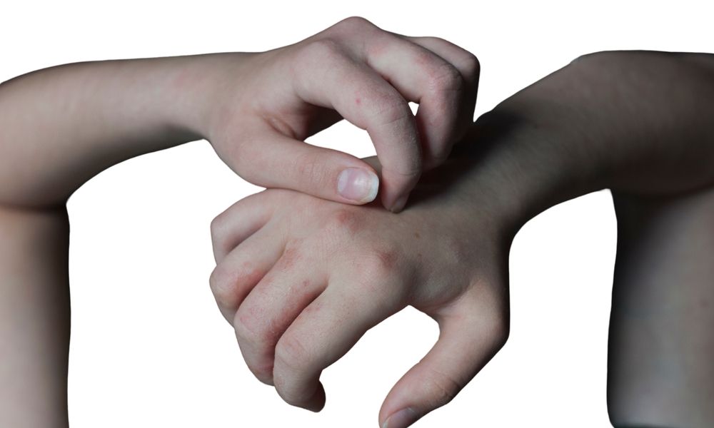 Signs,Of,Dermatitis,And,Scabies.,Skin,Allergy.,Condition,Caused,By