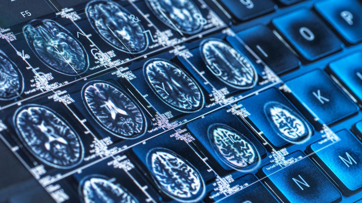 Áttörések az Alzheimer-kór elleni harcban: új remény a világszerte milliókat érintő betegség kezelésében 