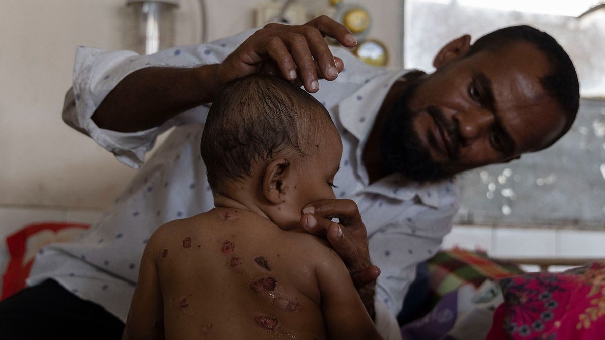 Bangladesben sürgősségi kanyaró elleni oltást vezettek be, miután a járvány már több mint 100 gyermek halálát okozta.